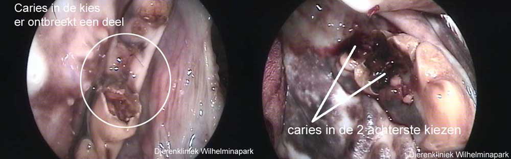 De helft van deze kies is door caries opgelost.